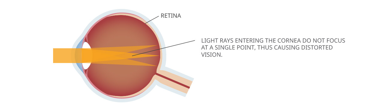 Astigmatism