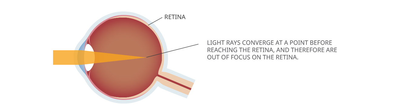 Myopia