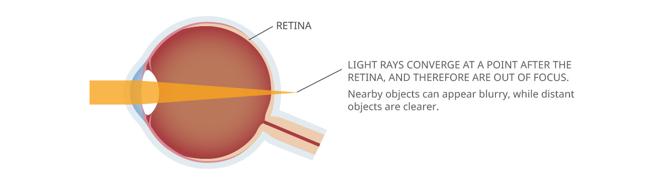 Presbyopia